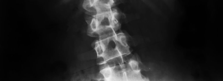 Spine xray