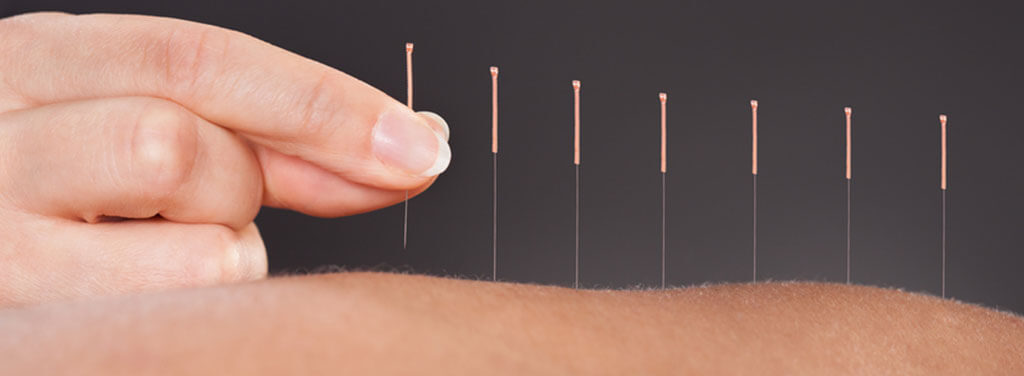 Woman's fingers holding onto acupuncture needles