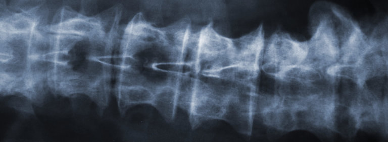 spine xray