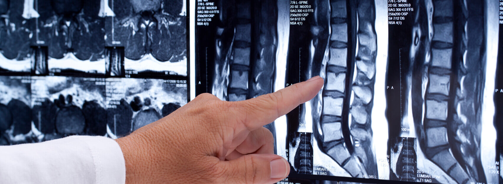 Doctor pointing to spine xray