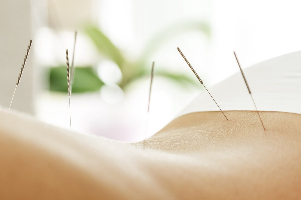 acupuncture for lower back pain