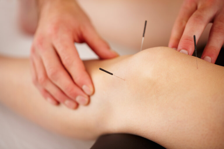 A practitioner's hands performing acupuncture on a person's knee.