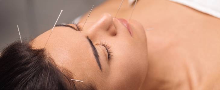 Woman with acupuncture needles in forehead.