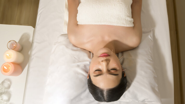 woman receiving acupuncture