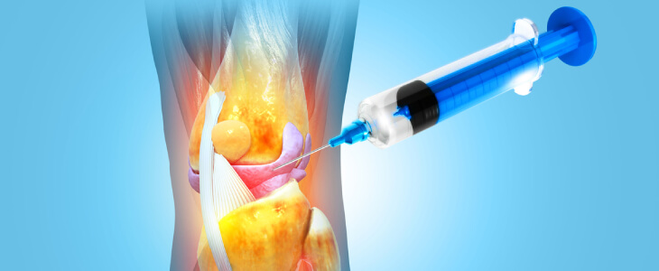 Corticosteroid injection in knee
