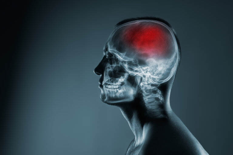 An X-ray of a man's head with a red highlighted area on the brain.