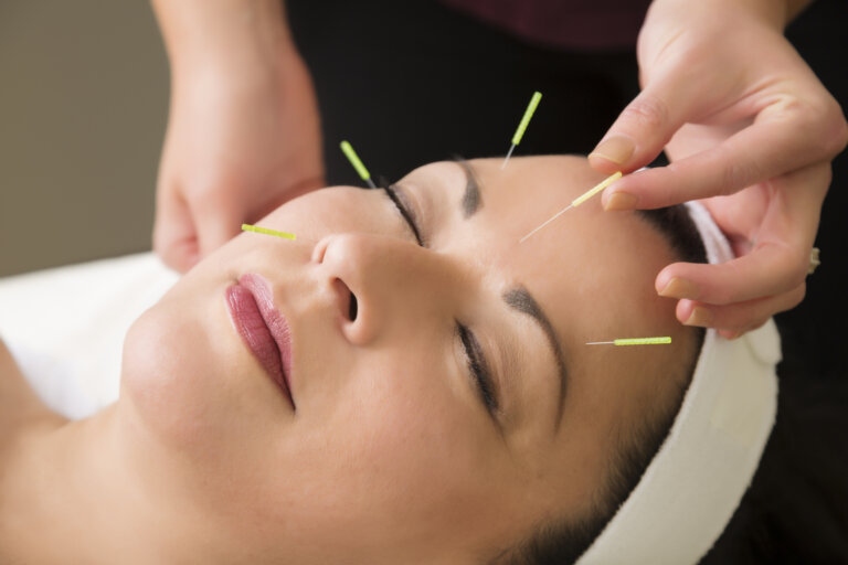 middle aged woman in the spa getting acupuncture treatment
