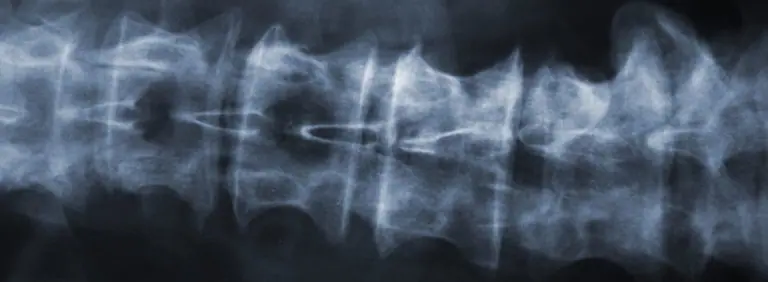 spine xray