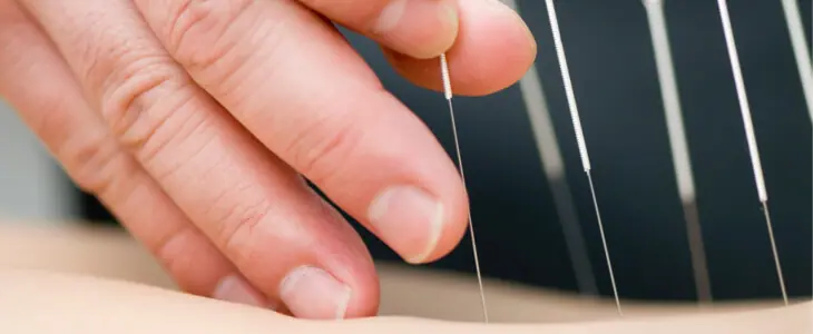 A close-up of a person's hand inserting acupuncture needles into a patient's back.