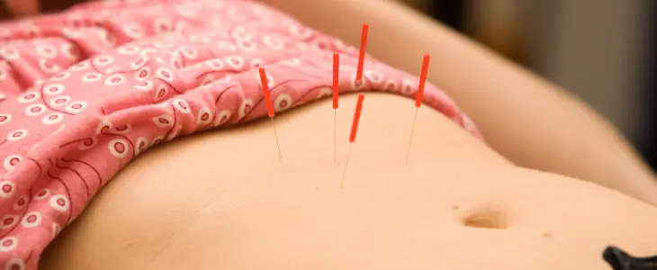 Women with acupuncture needles in belly