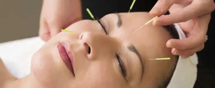 middle aged woman in the spa getting acupuncture treatment